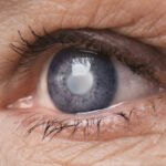 Cataract Awareness Symptoms, Diagnosis, and Treatment