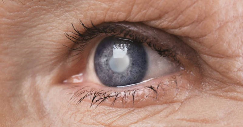 Cataract Awareness Symptoms, Diagnosis, and Treatment