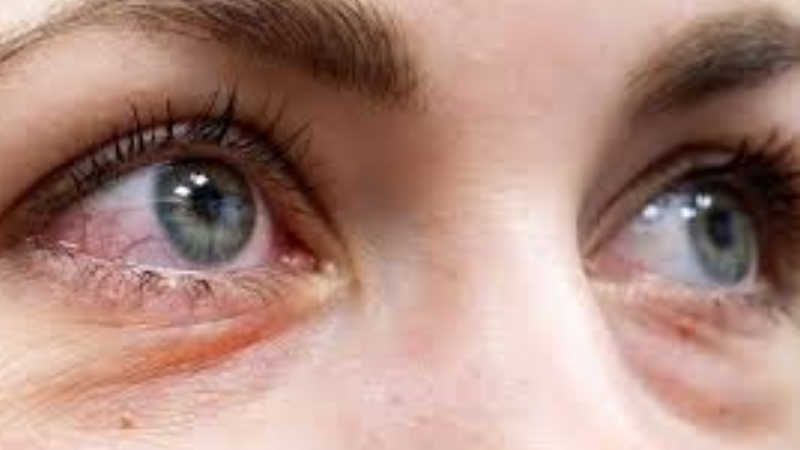 Tired of Red, Irritated Eyes? Blepharitis Could Be to Blame