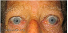 The connection between thyroid health and eye conditions