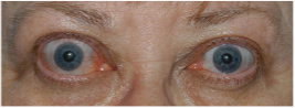 The connection between thyroid health and eye conditions